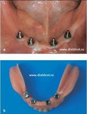 Протезирование при помощи имплантации зубов.