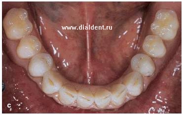 Протезирование при помощи имплантации зубов. Семейный стоматологический центр "Диал-Дент"