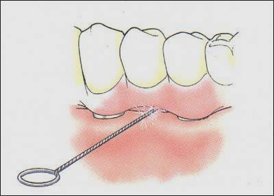 чистка зубов на имплантатах
