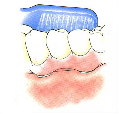 чистка зубов на имплантатах